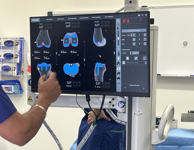 Robotic-assisted knee replacement surgical system displaying multiple 3D imaging views of knee anatomy with measurement data and surgical planning interface on monitor